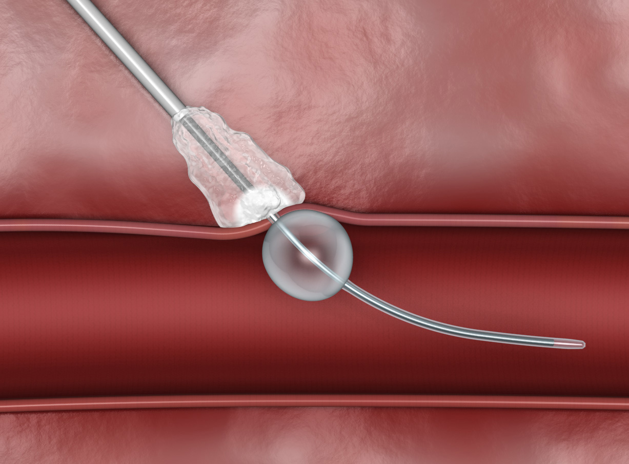 Transradial Closure Devices Market