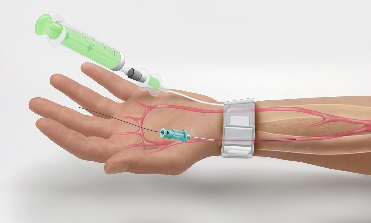 Vascular Closure Devices Industry