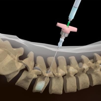 Vertebroplasty And Kyphoplasty Devices Industry