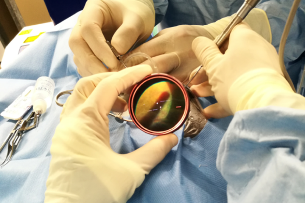 Vitrectomy Devices Industry