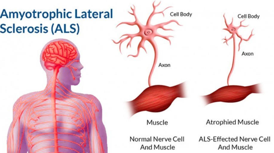 Amyotrophic Lateral Sclerosis Market