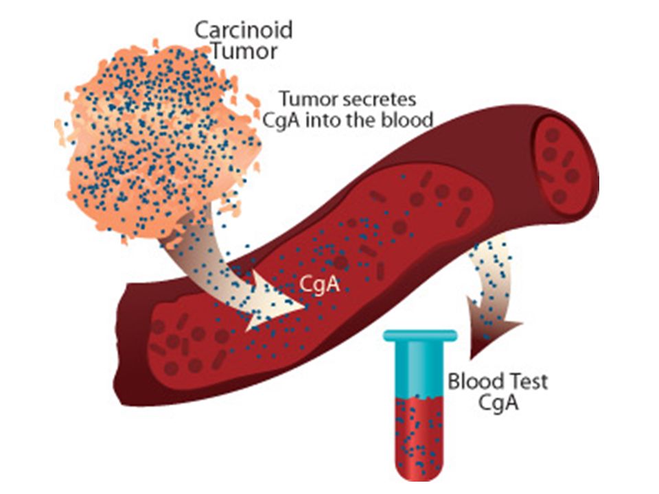 Carcinoid Tumor Syndrome Management Market