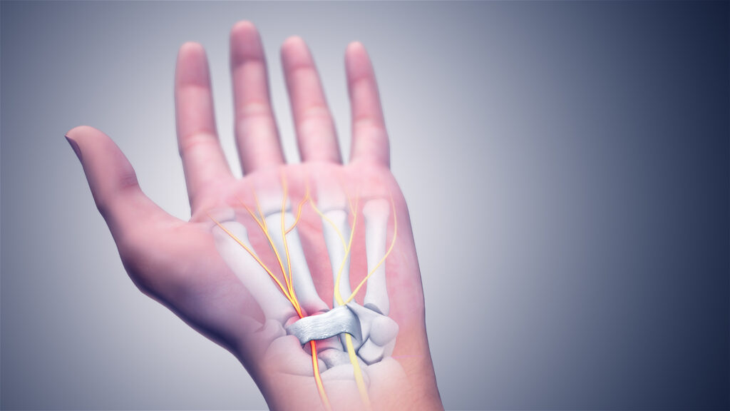 Global Carpal Tunnel Release System Market