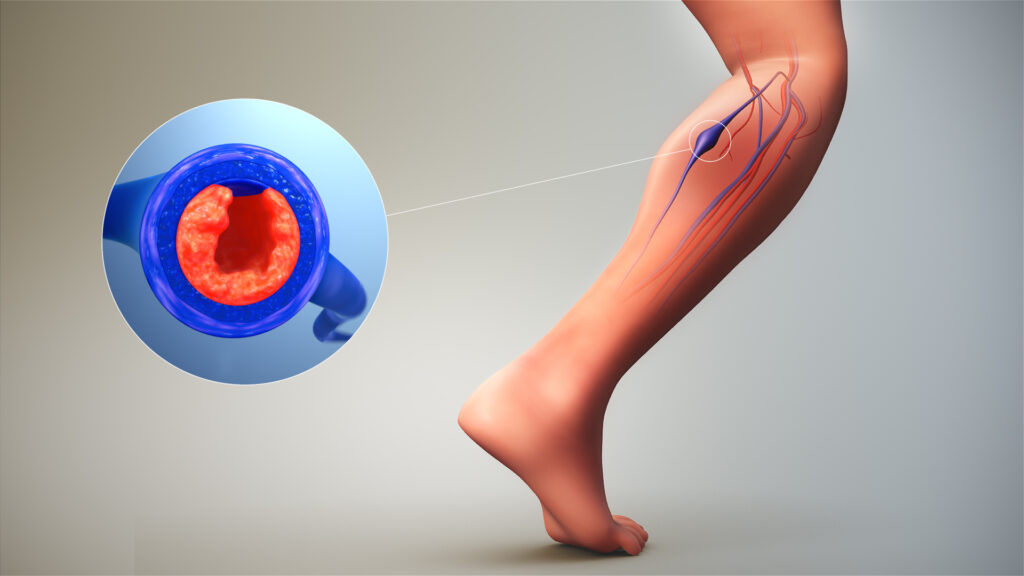 Cerebral Vein Thrombosis Treatment Market