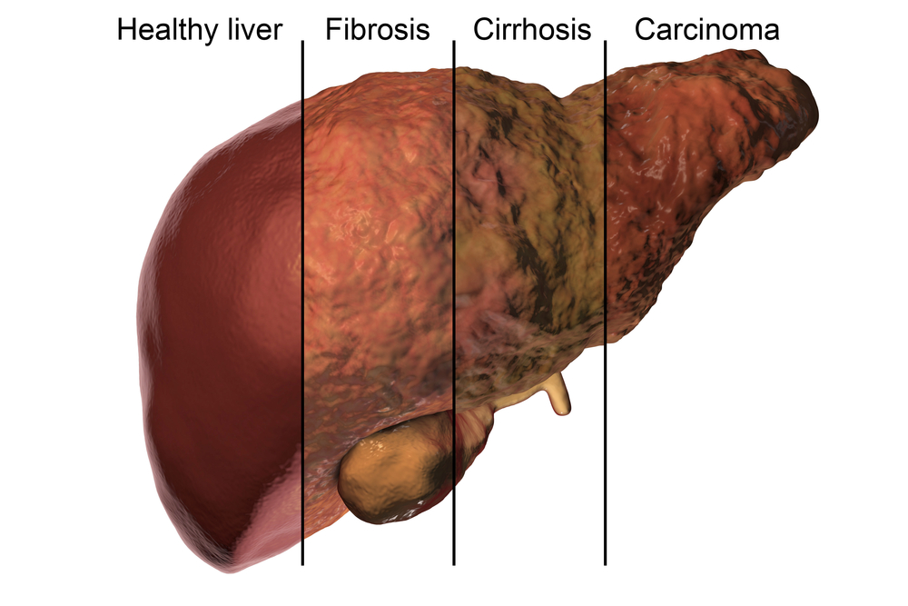 Cirrhosis Management Industry