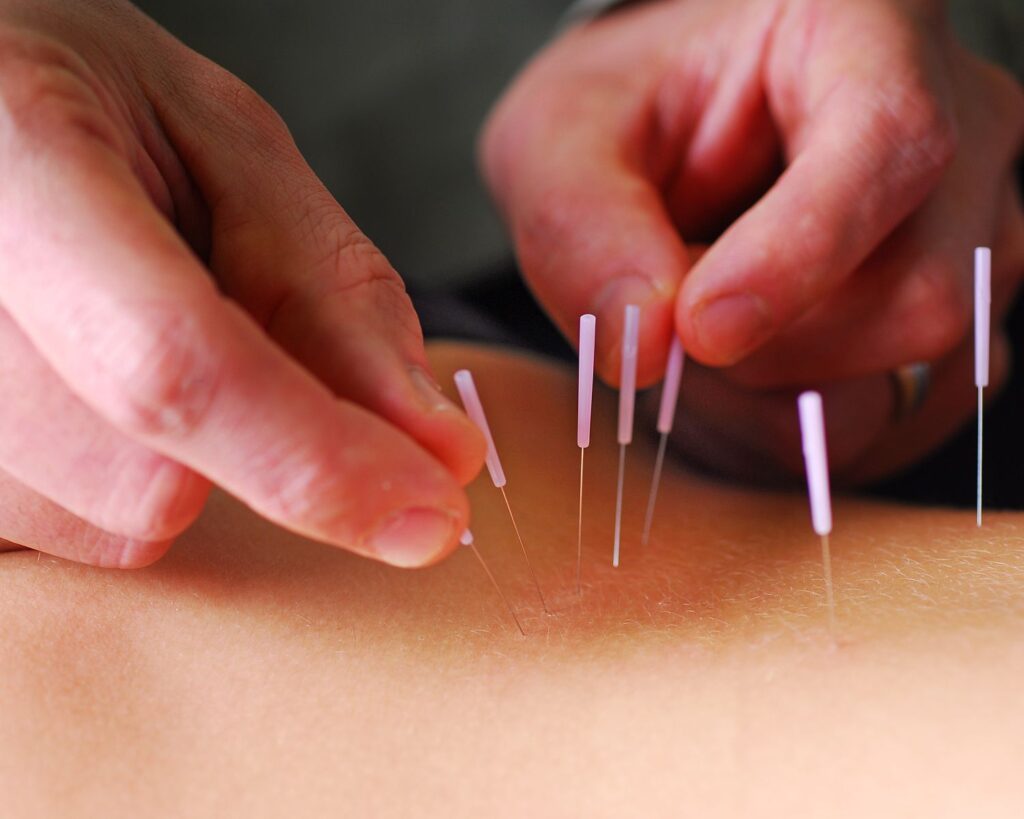 Electric Acupuncture Devices Industry