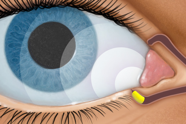 Global Ocular Drug Delivery System Industry