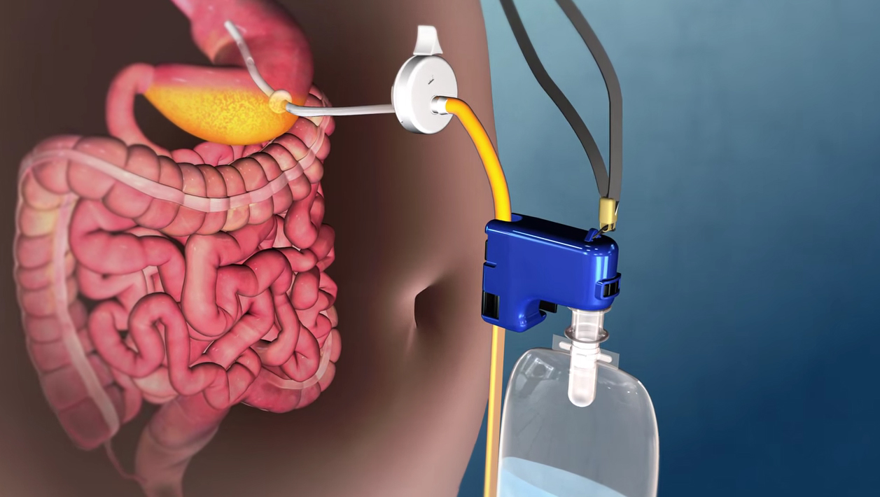 Global Bariatric Surgery Devices Industry