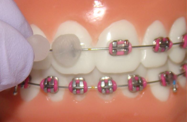 Global Dental Orthodontic Wax Industry