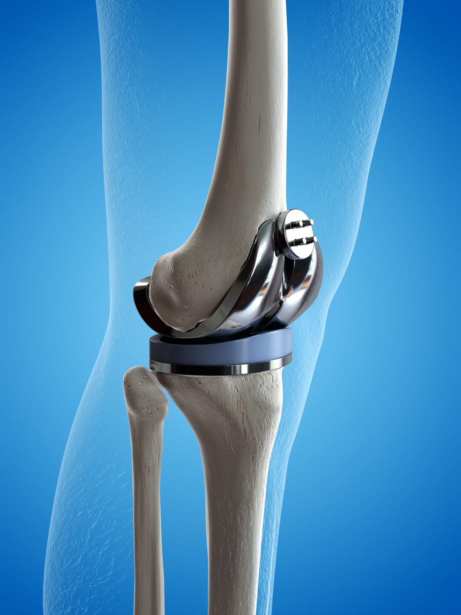 Global Knee Replacement Industry