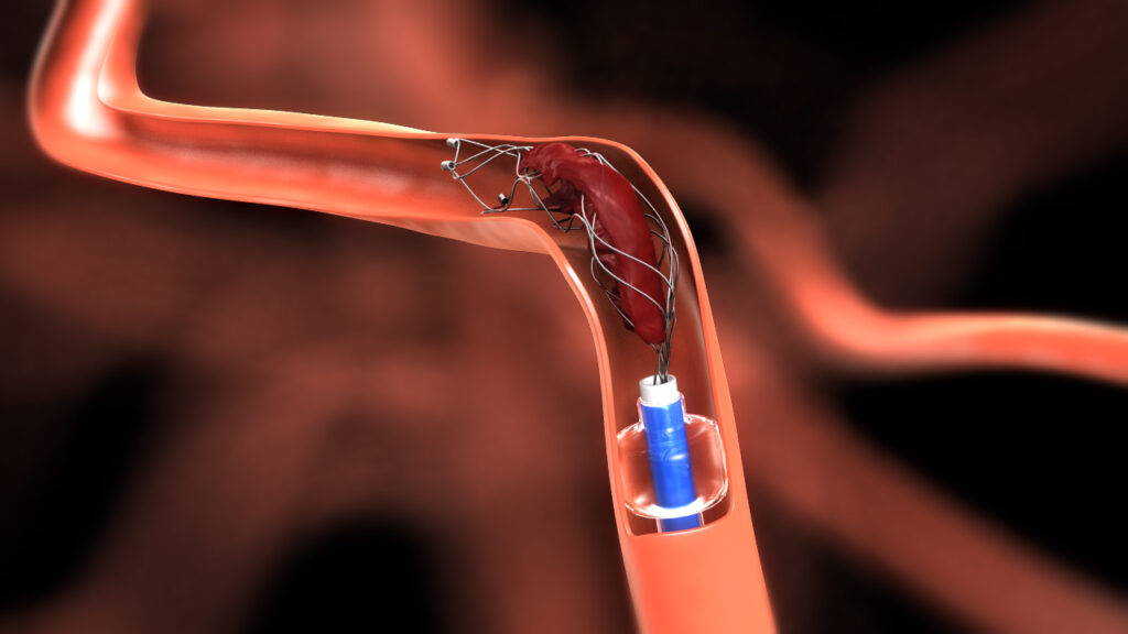 India Coronary Stent Market