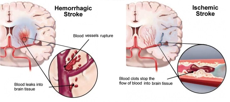 Ischemic Stroke Aspiration Systems Market