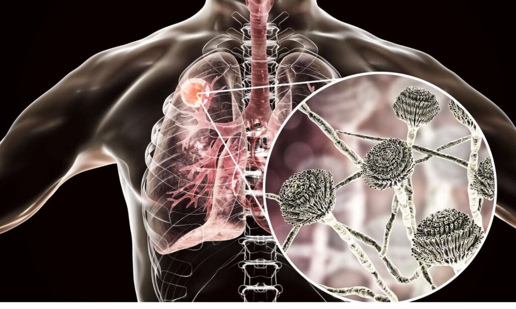 Lung Disease Therapeutics Market