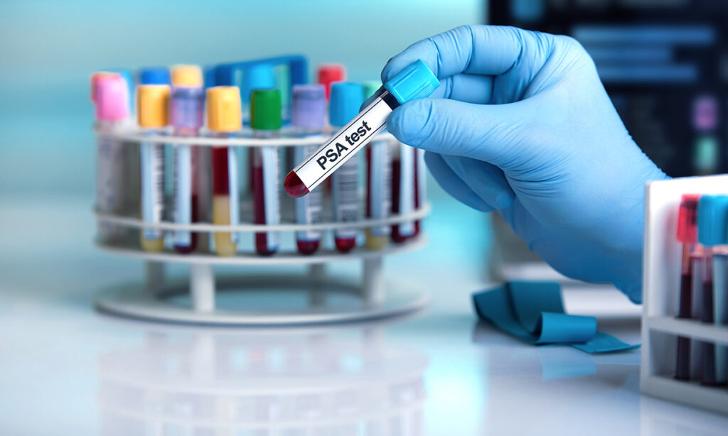 Prostate-Specific Antigen Testing Market