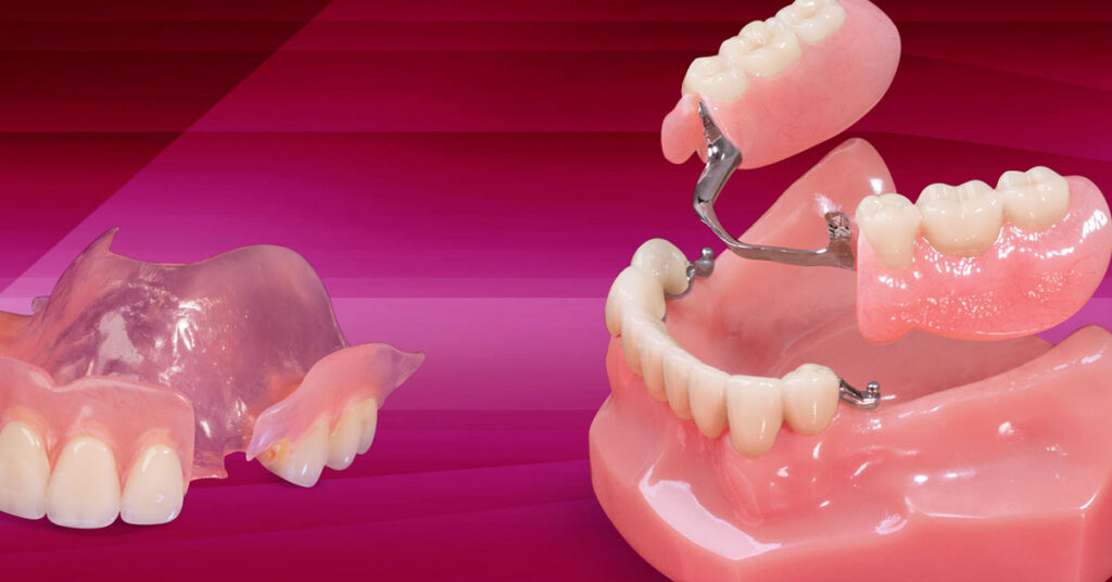 Removable Partial Dentures Market