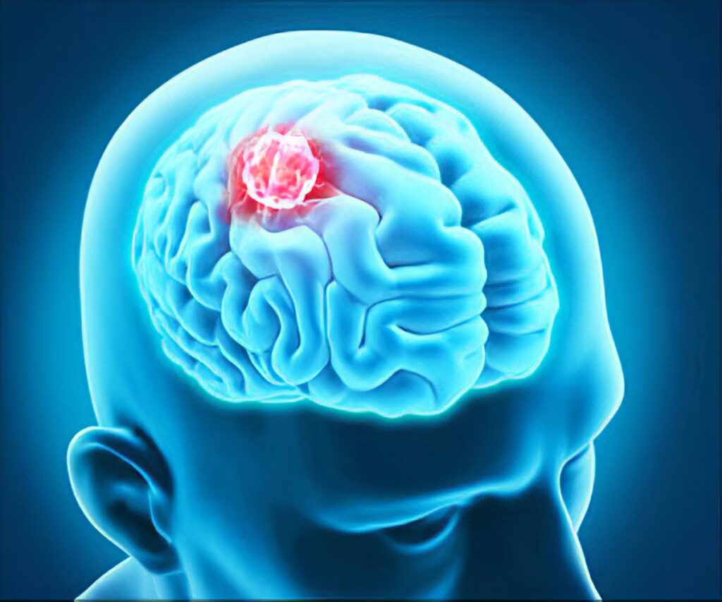 Brain Tumor Drugs Market