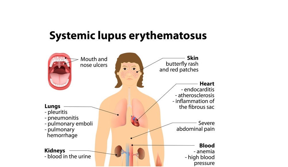 Systemic Lupus Erythematous Drugs Industry