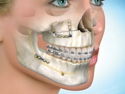 3D Printed Maxillofacial Implants Market