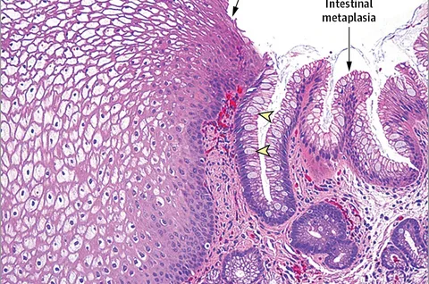 Barrett’s Esophagus with Dysplasia Treatment Market