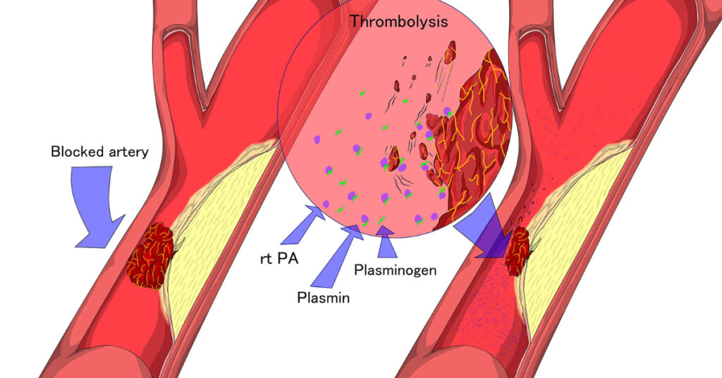 Catheter-Directed Thrombolysis Industry