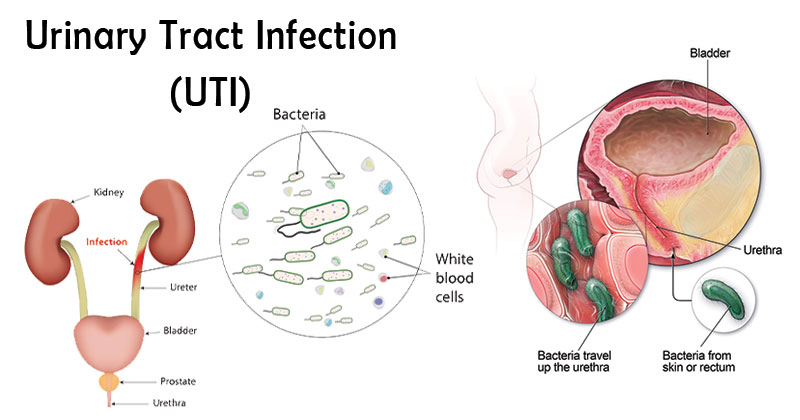 Complicated Urinary Tract Infections Treatment Industry