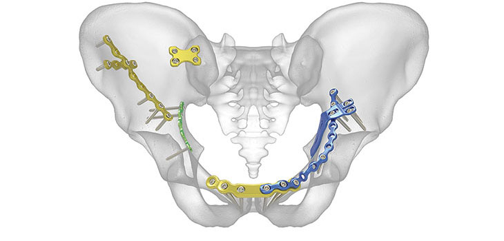 Female Pelvic Implants Industry