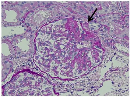 Focal Segmental Glomerulosclerosis (FSGS) Therapeutics Market