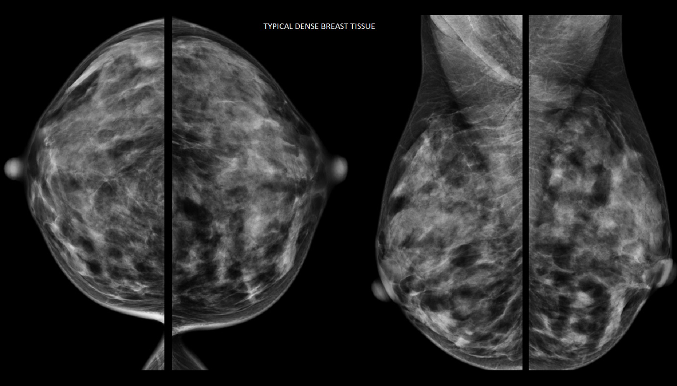 Global Breast Imaging Industry