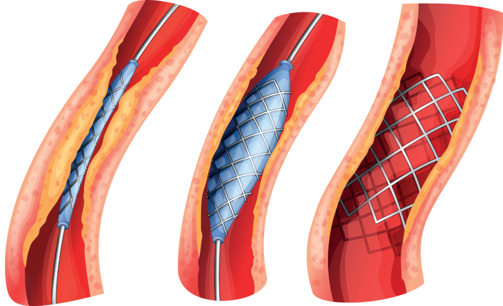 Global Coronary Stents Industry