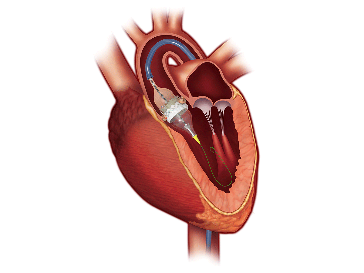 Global Transcatheter Heart Valve Replacement Industry