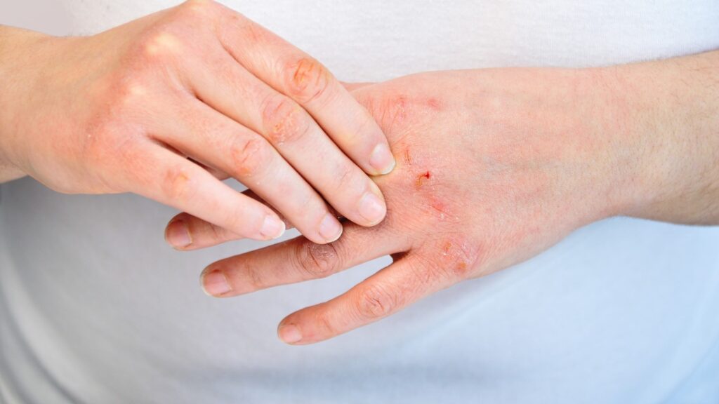 Hand Eczema (HE) Treatment Market