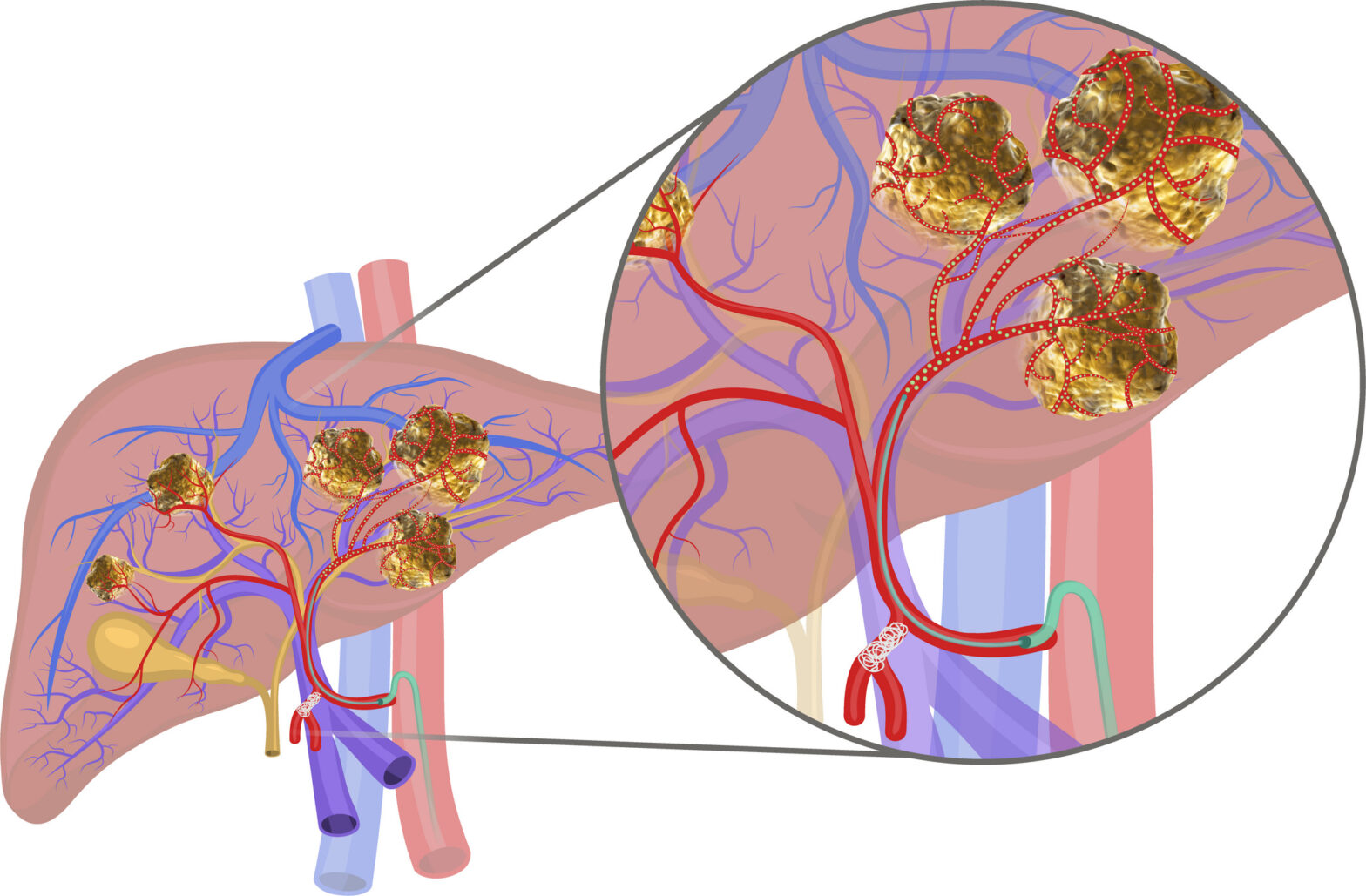 Global Internal Radiation Therapy Industry