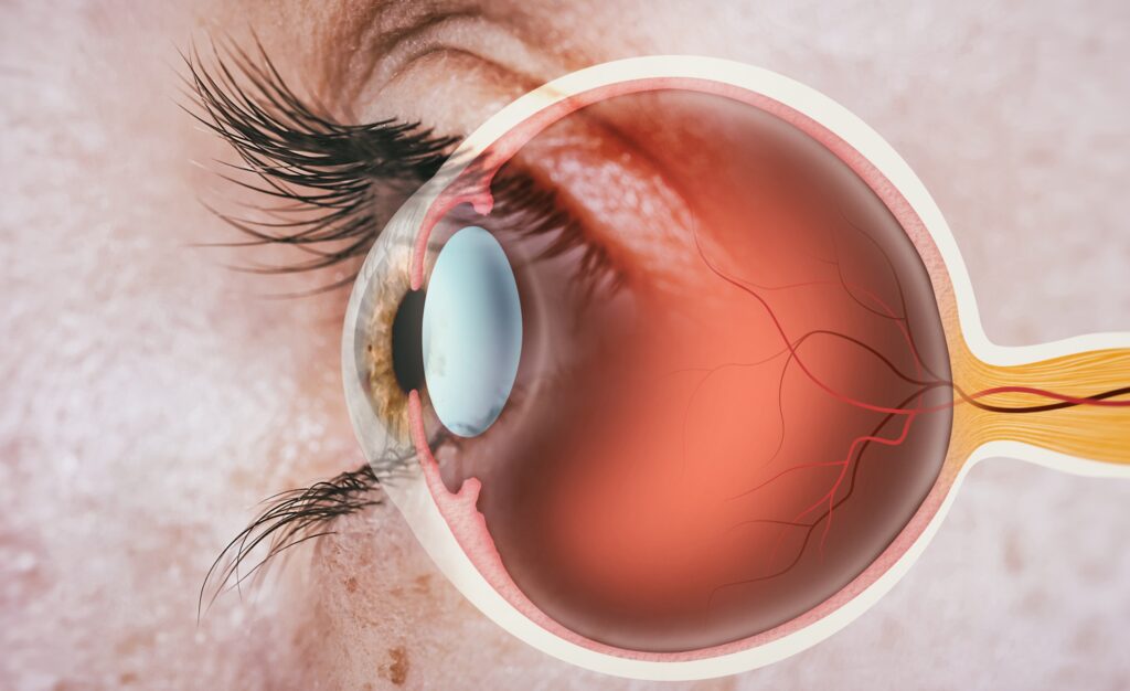 Neovascular Age-related Macular Degeneration Treatment Industry