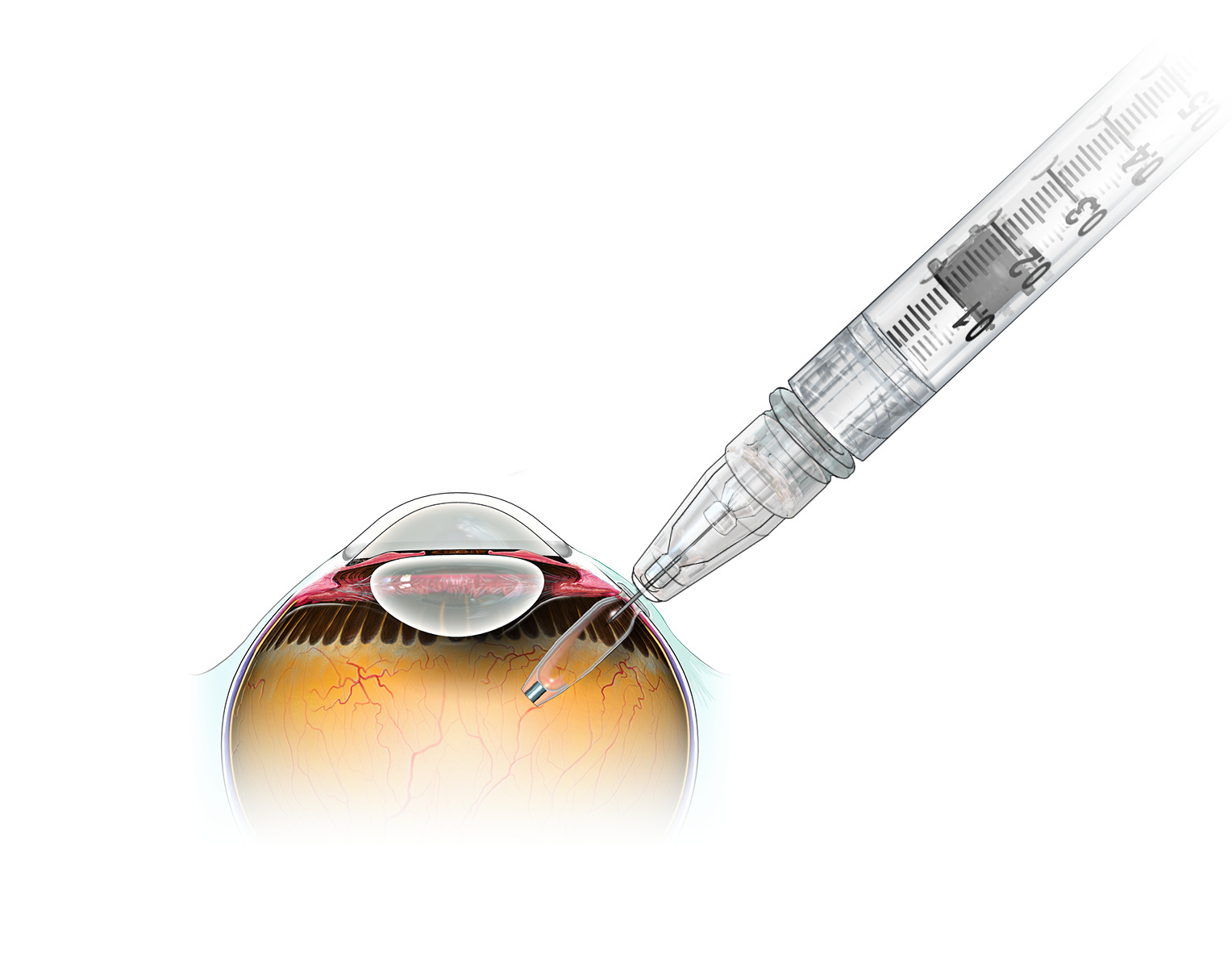 Ocular Drug Delivery System Industry