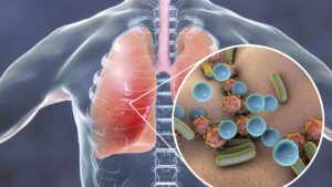 Pneumonia Diagnostics Industry