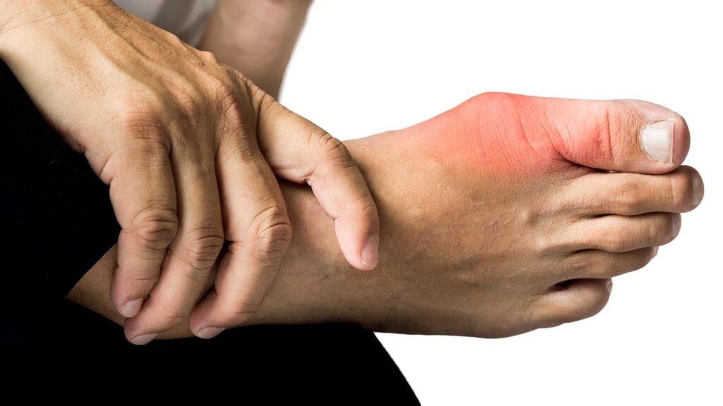 Psoriatic Arthritis (PsA) Treatment Industry