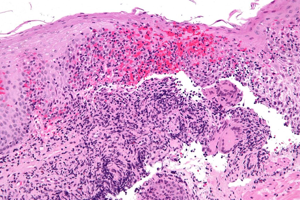 Rosai-Dorfman Disease Therapeutics Market