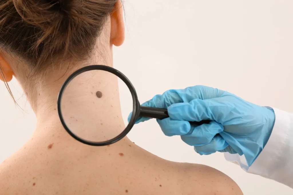 Skin Cancer Detection Devices Market