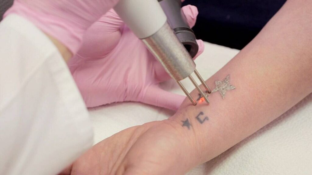 Tattoo Removal Lasers Industry