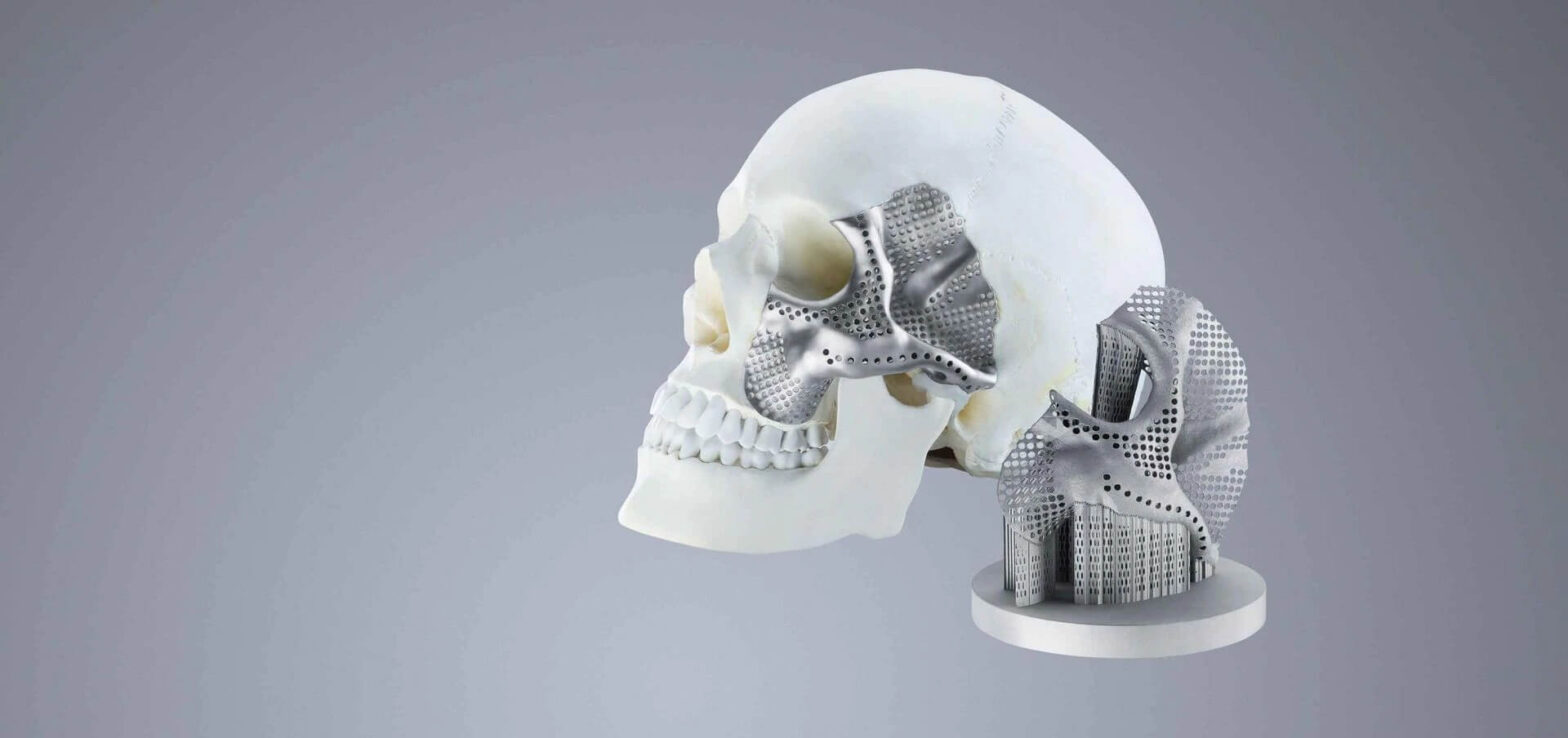 Global 3D Printed Medical Implants Industry