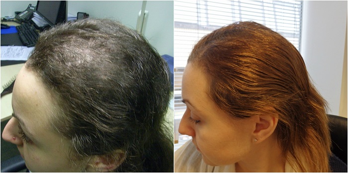 Alopecia Treatment Industry