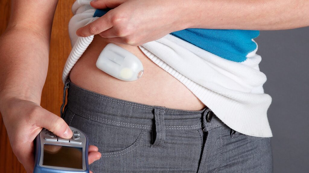 Artificial Pancreas Device Systems Industry