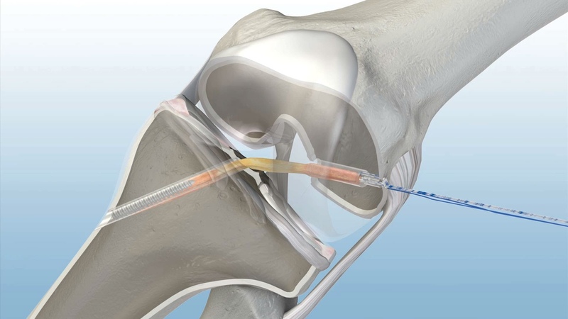 Bone Graft Fixation System Market