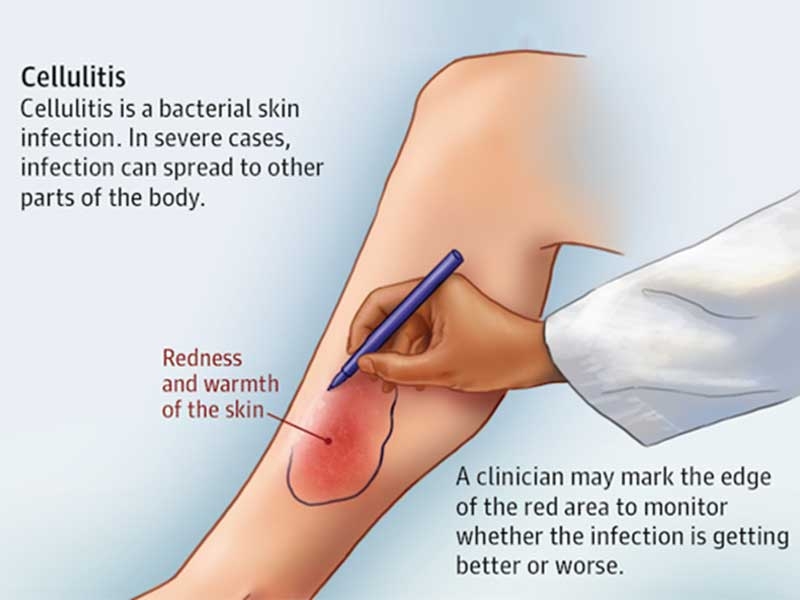 Cellulitis Management Market