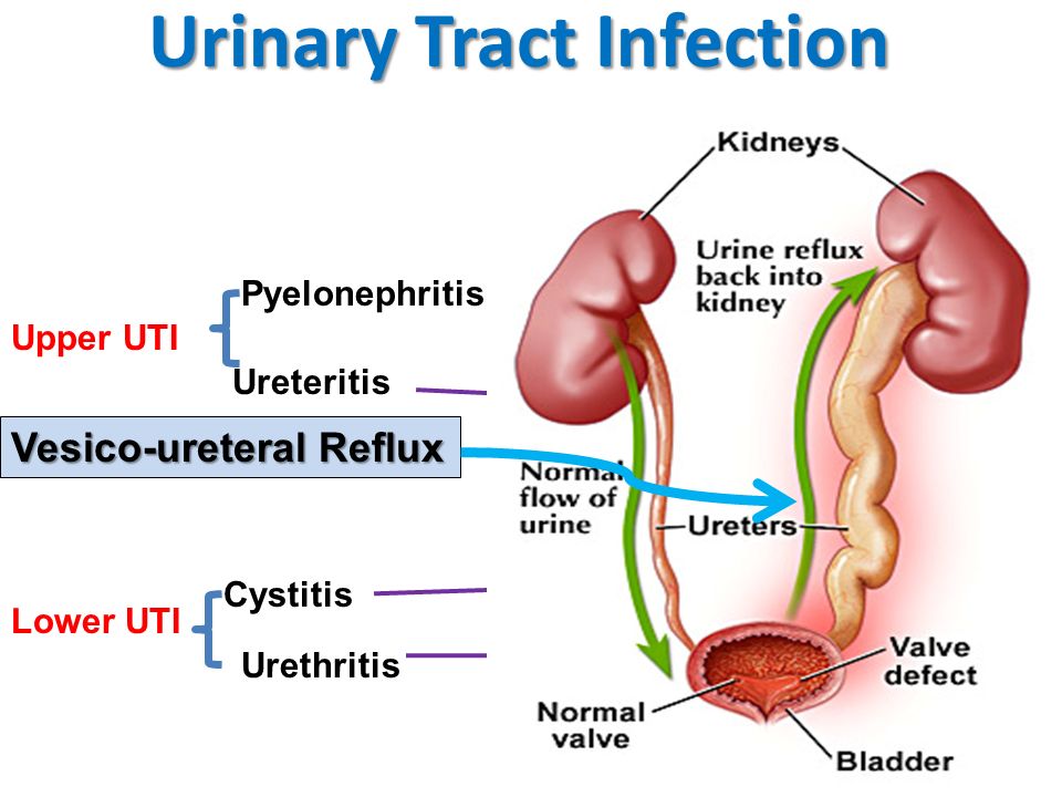 Complicated Urinary Tract Infections Treatment Industry