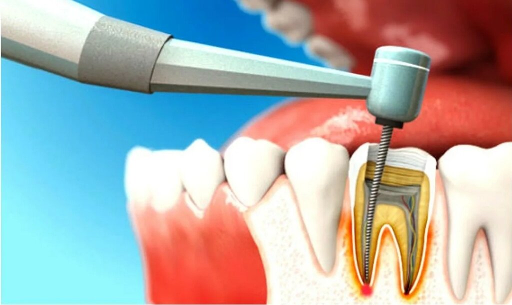 Dental Caries and Endodontic Industry