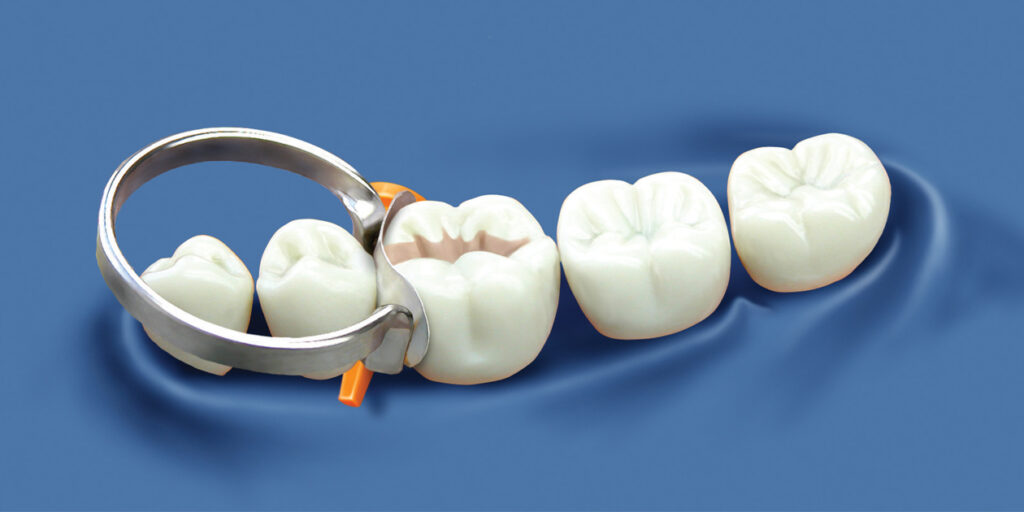 Dental Matrix Systems Industry