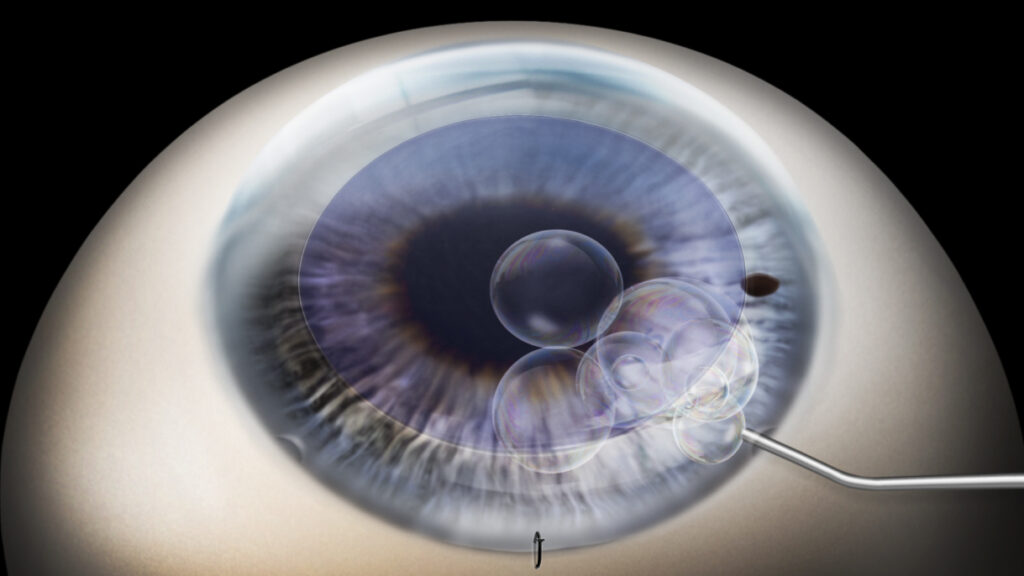 Fuchs Endothelial Corneal Dystrophy (FECD) Industry