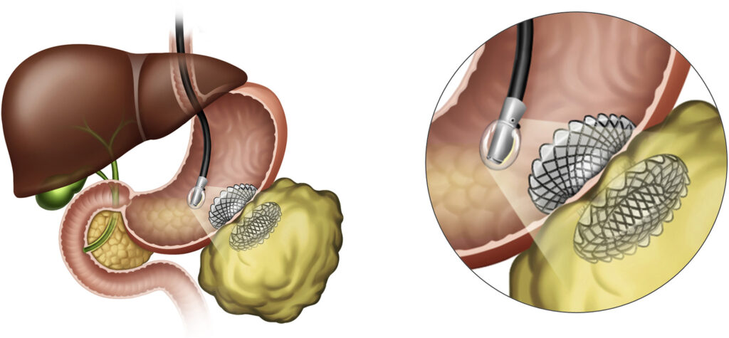 Gastrointestinal Stent Industry