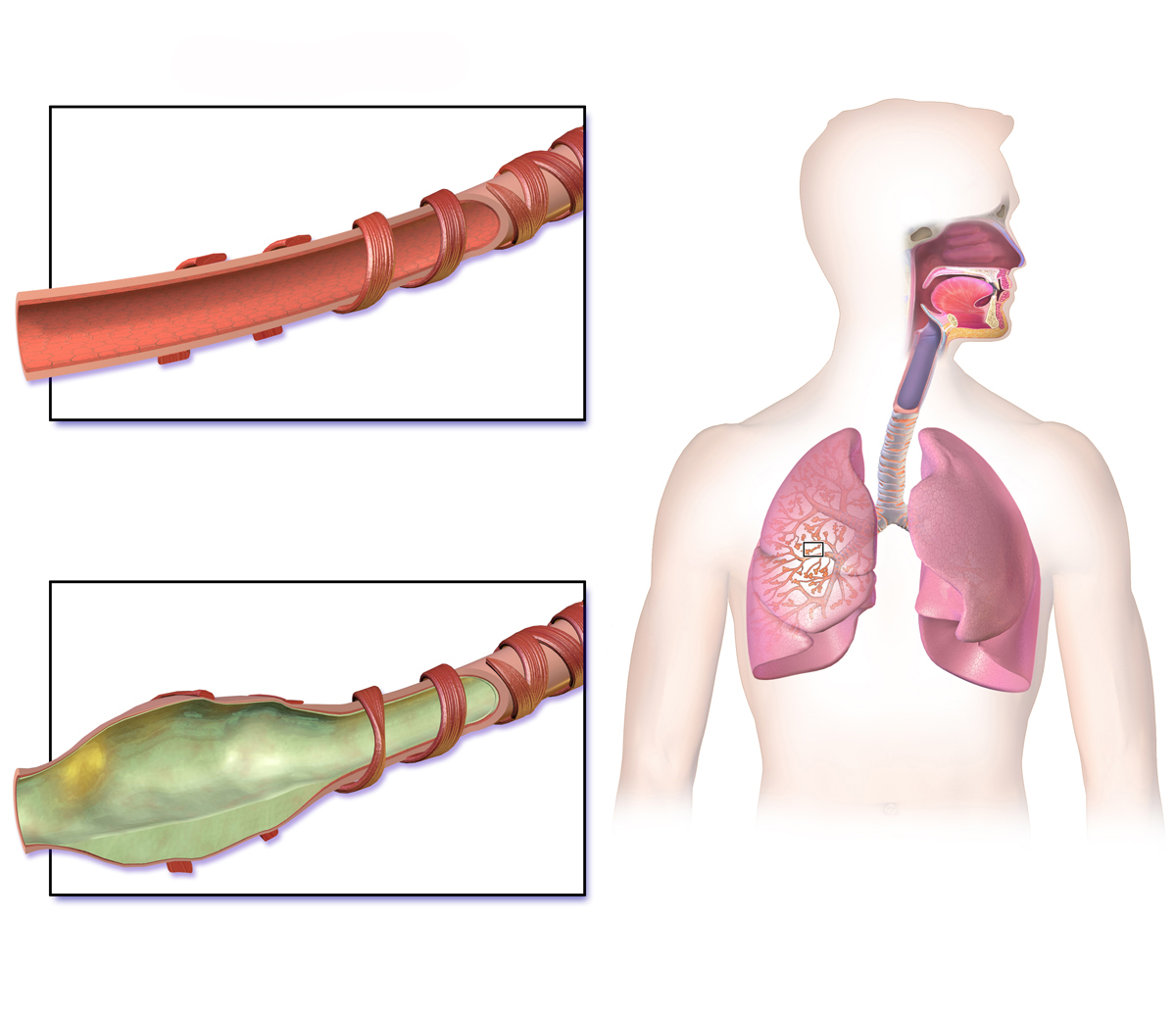 Global Airway Disease Treatment Industry